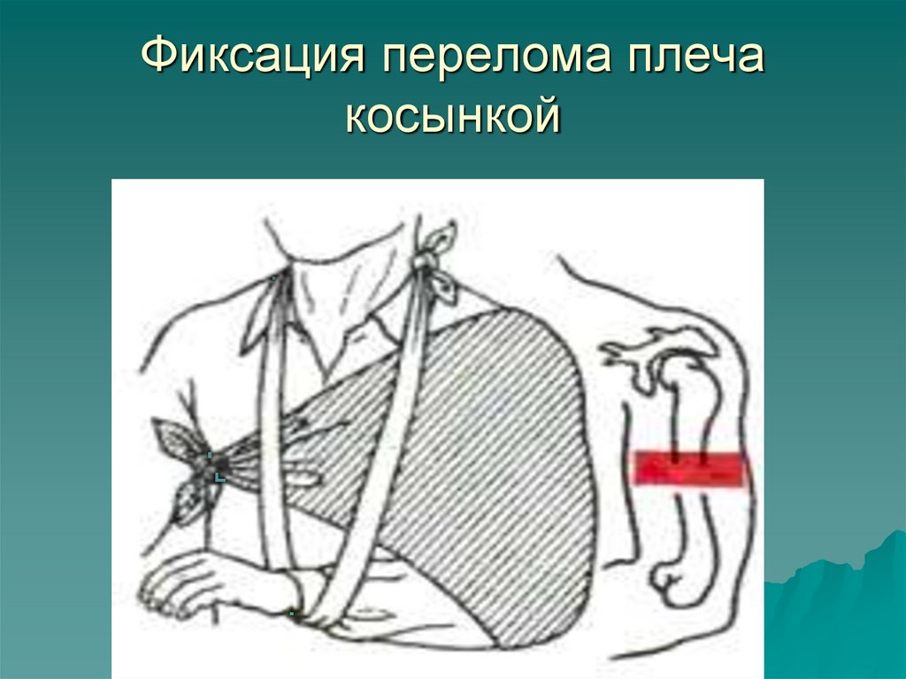 Фиксация перелома плеча косынкой