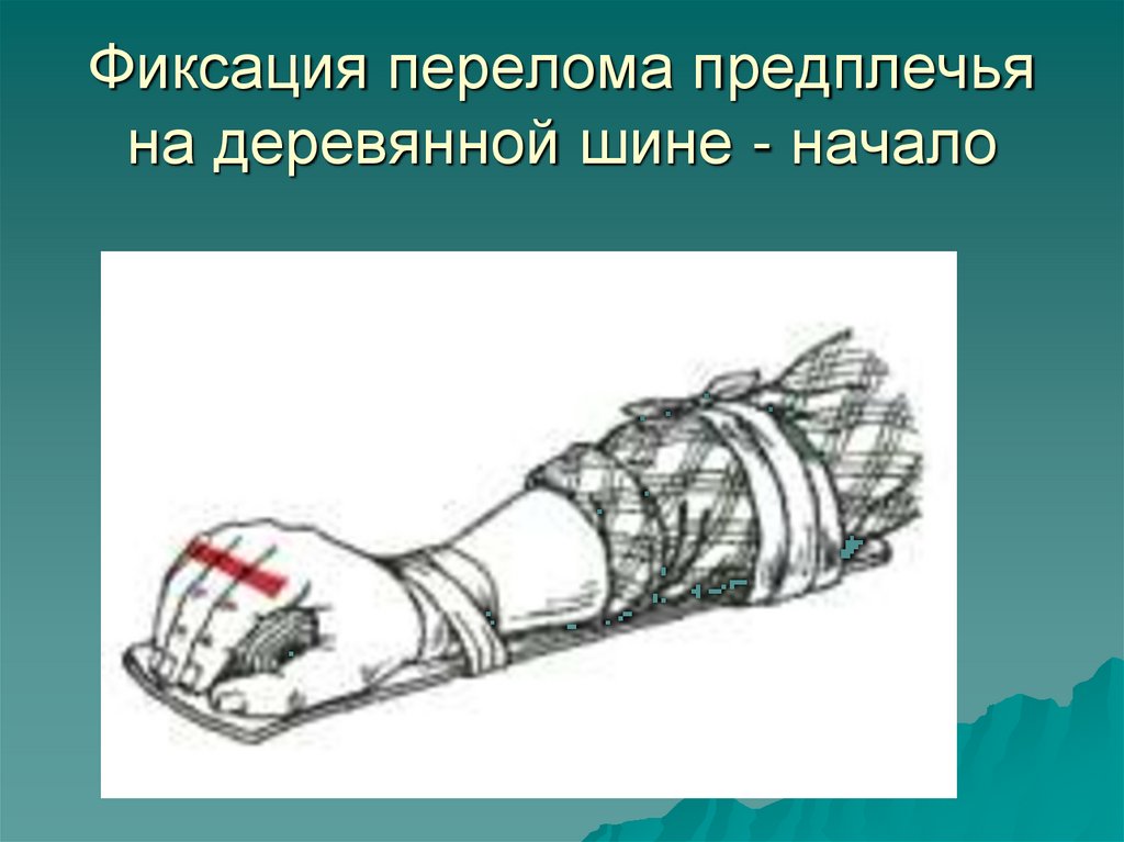 Фиксация перелома предплечья на деревянной шине - начало