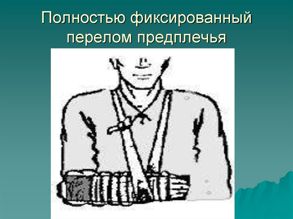 Полностью фиксированный перелом предплечья