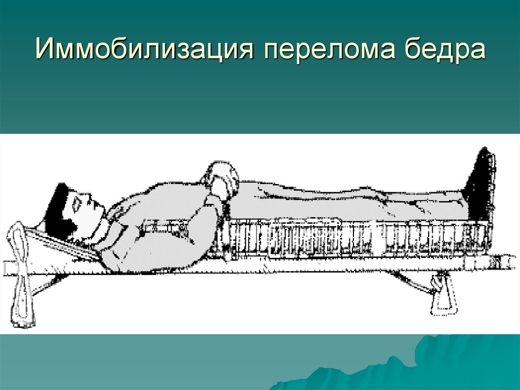 Иммобилизация перелома бедра