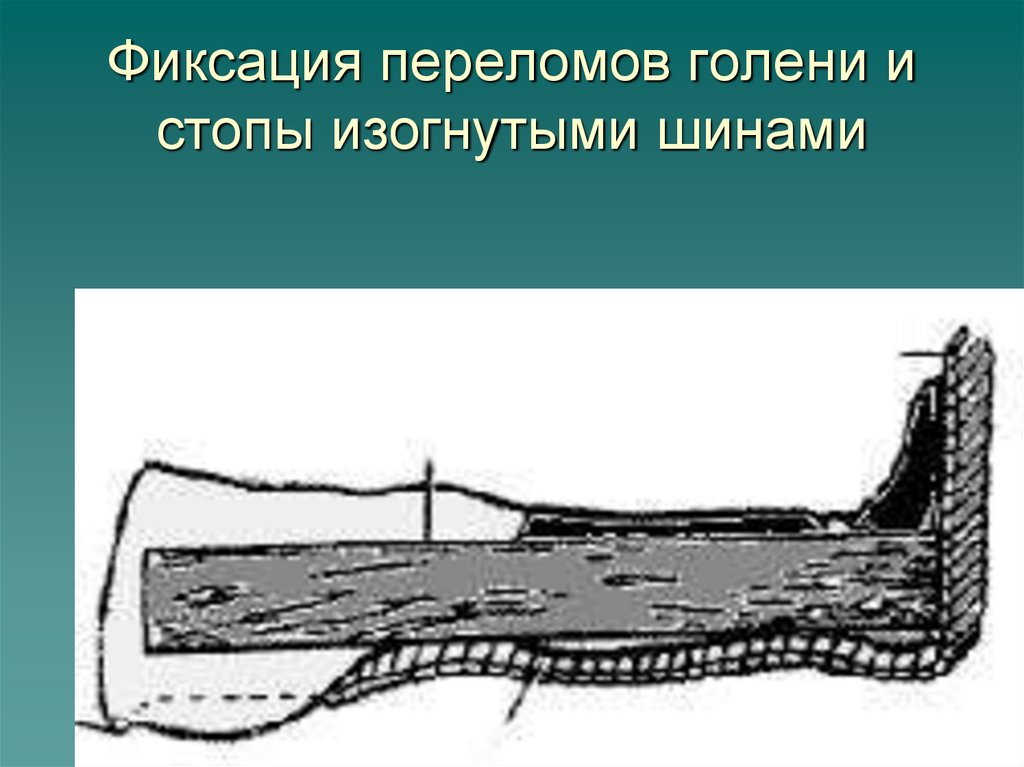 Фиксация переломов голени и стопы изогнутыми шинами