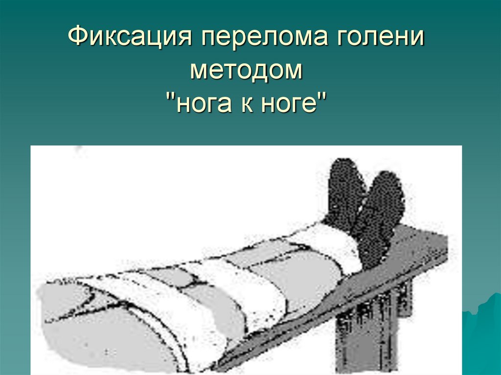 Фиксация перелома голени методом "нога к ноге"