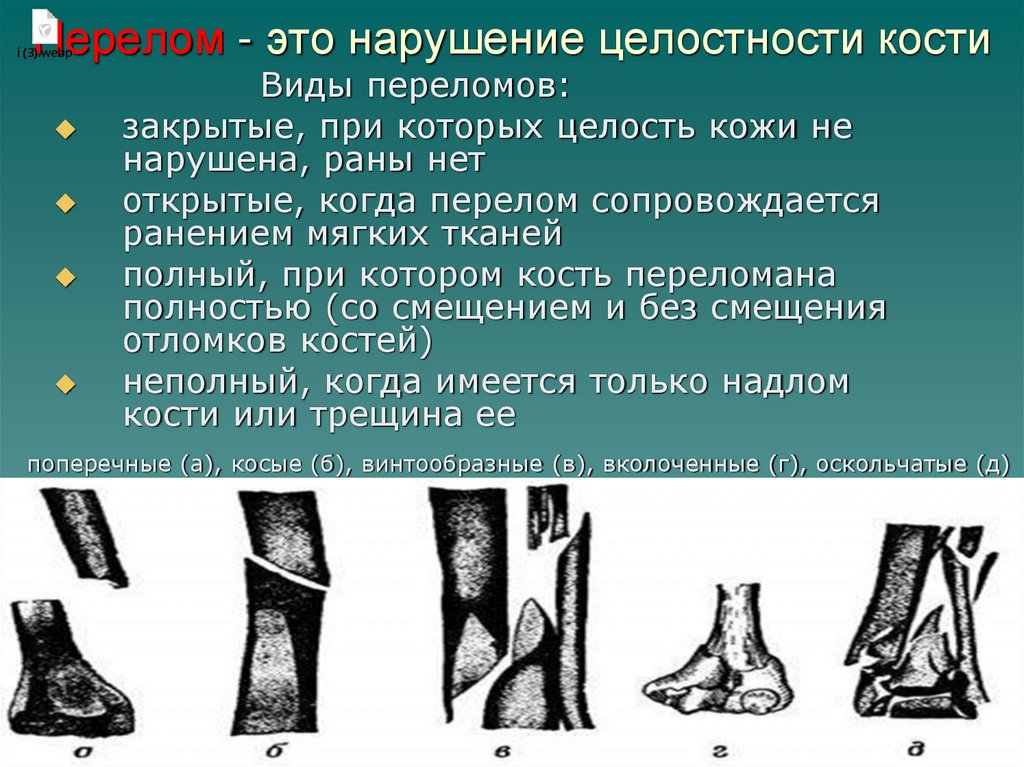 Перелом - это нарушение целостности кости