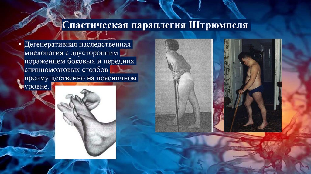 Спастическая параплегия Штрюмпеля