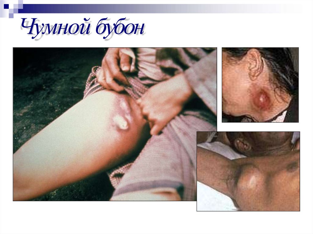 Чумной бубон