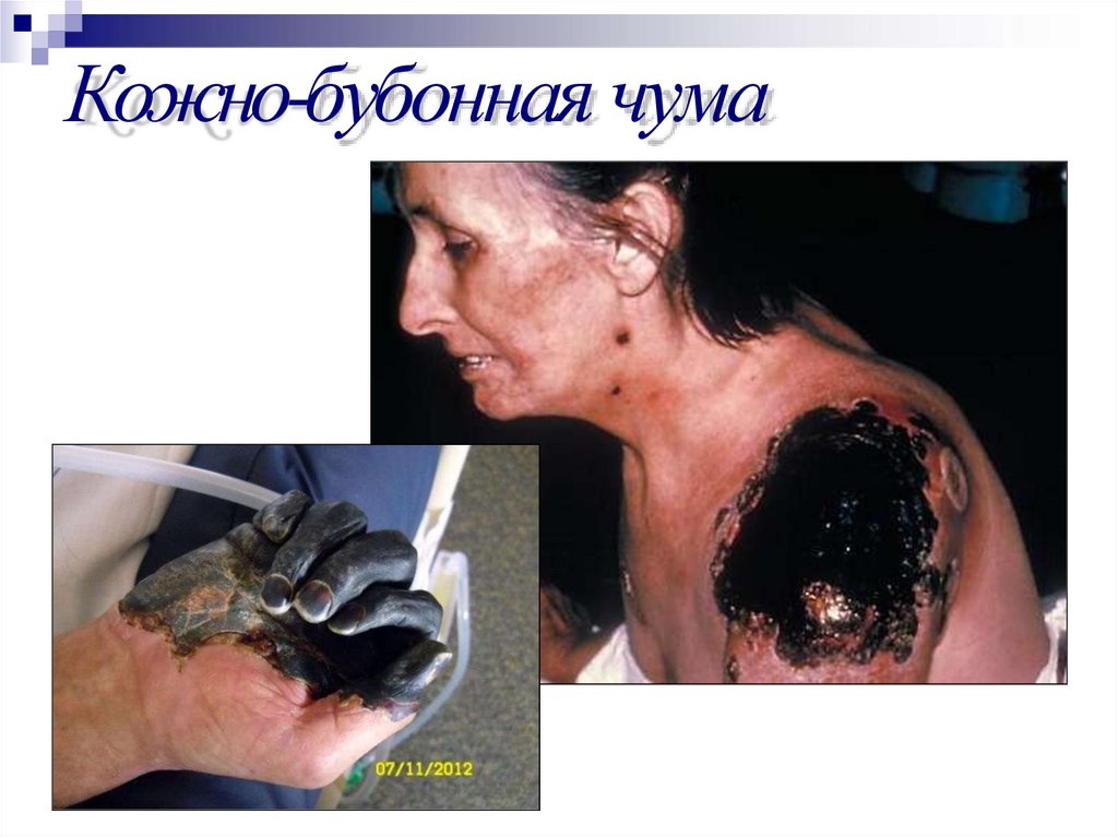 Кожно-бубонная чума