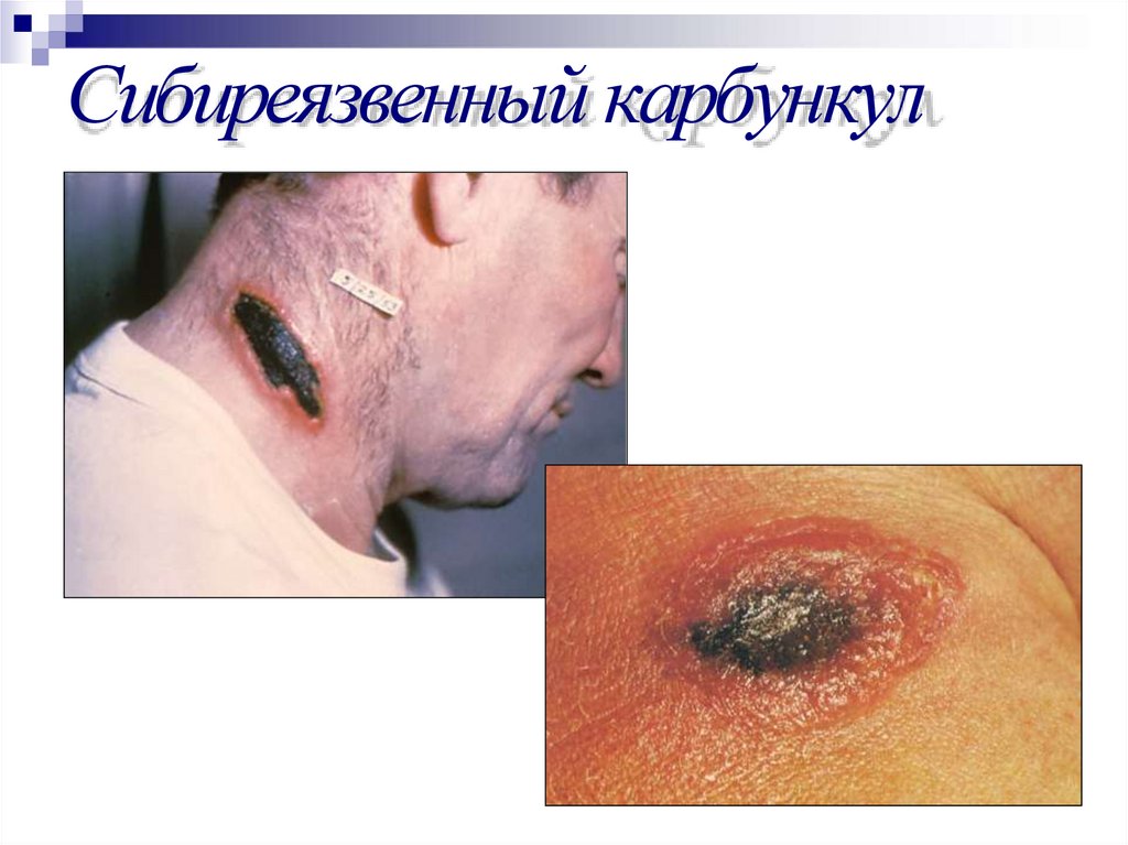 Сибиреязвенный карбункул