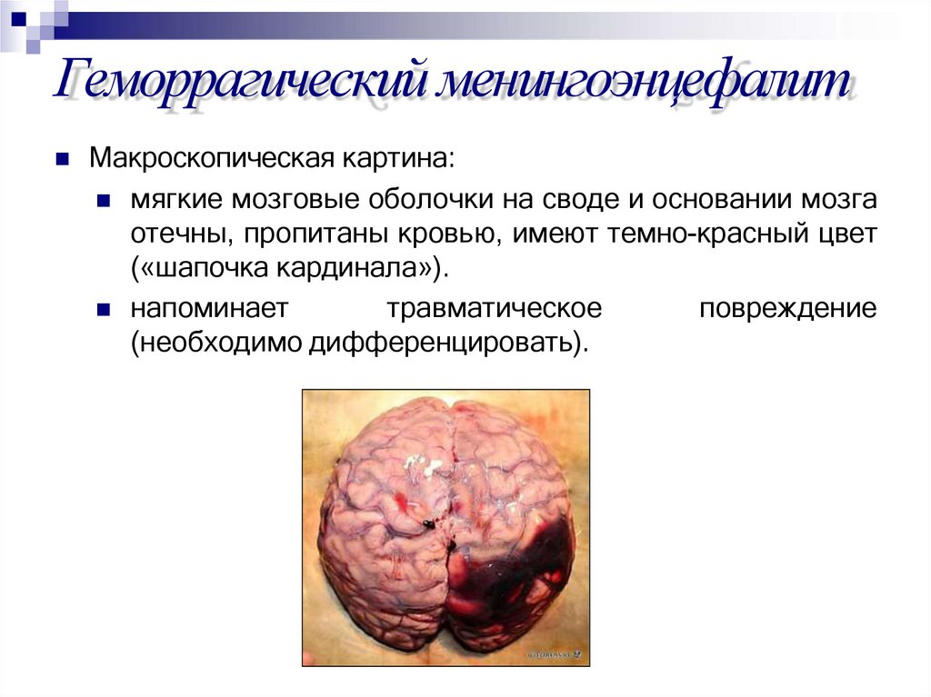 Геморрагический менингоэнцефалит