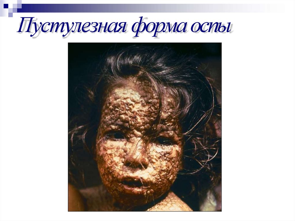 Пустулезная форма оспы