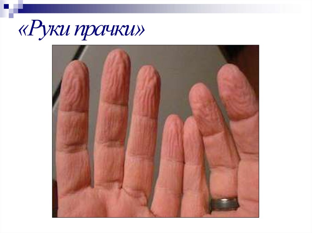 «Руки прачки»