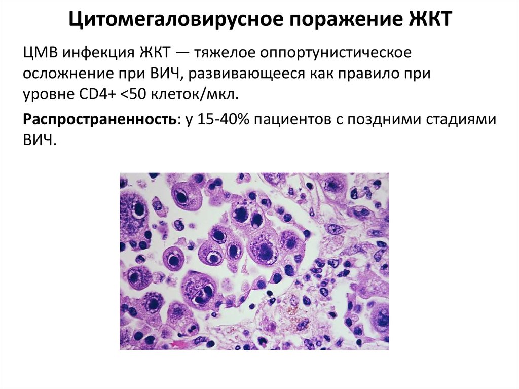 Цитомегаловирусное поражение ЖКТ
