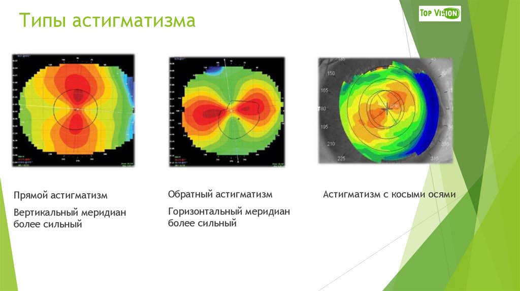 Типы астигматизма