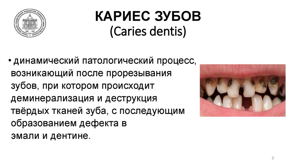 КАРИЕС ЗУБОВ (Caries dentis)