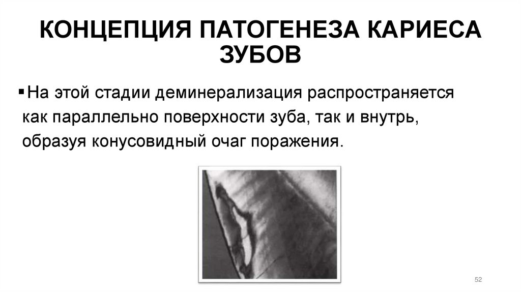 КОНЦЕПЦИЯ ПАТОГЕНЕЗА КАРИЕСА ЗУБОВ