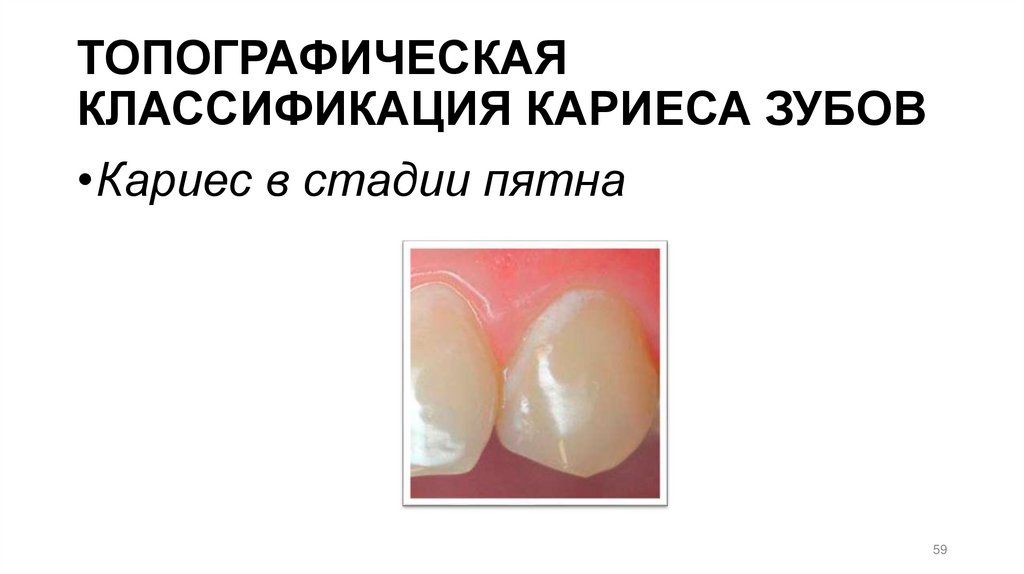 ТОПОГРАФИЧЕСКАЯ КЛАССИФИКАЦИЯ КАРИЕСА ЗУБОВ