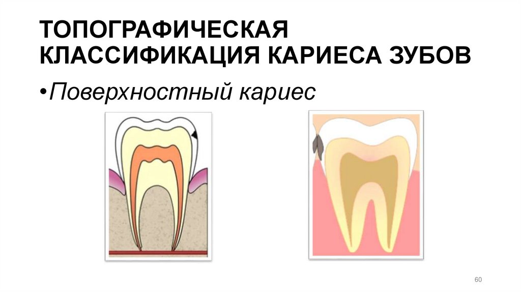 ТОПОГРАФИЧЕСКАЯ КЛАССИФИКАЦИЯ КАРИЕСА ЗУБОВ