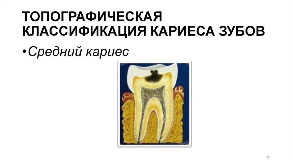 ТОПОГРАФИЧЕСКАЯ КЛАССИФИКАЦИЯ КАРИЕСА ЗУБОВ