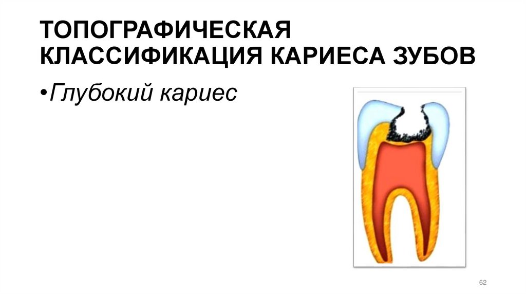 ТОПОГРАФИЧЕСКАЯ КЛАССИФИКАЦИЯ КАРИЕСА ЗУБОВ