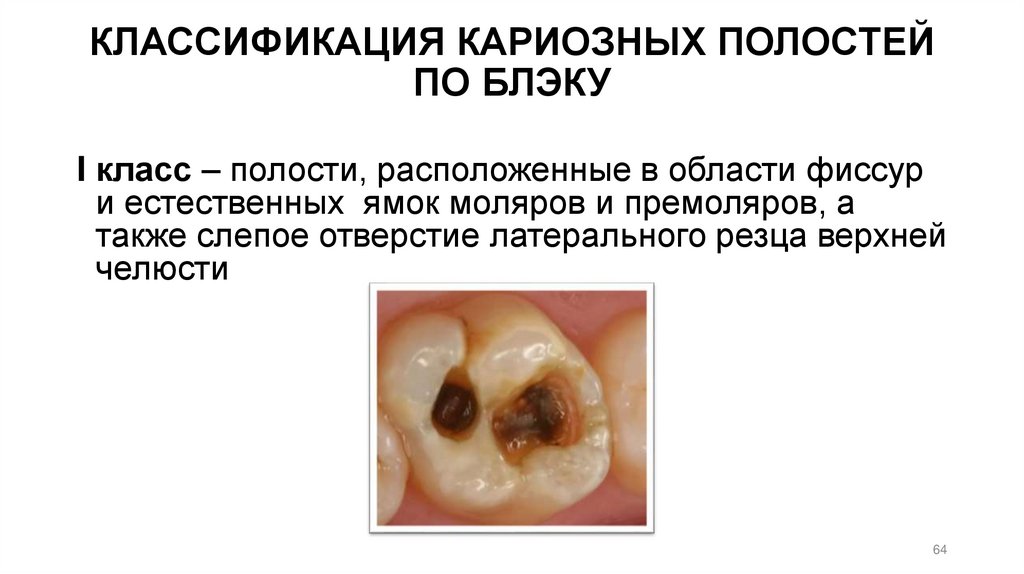 КЛАССИФИКАЦИЯ КАРИОЗНЫХ ПОЛОСТЕЙ ПО БЛЭКУ