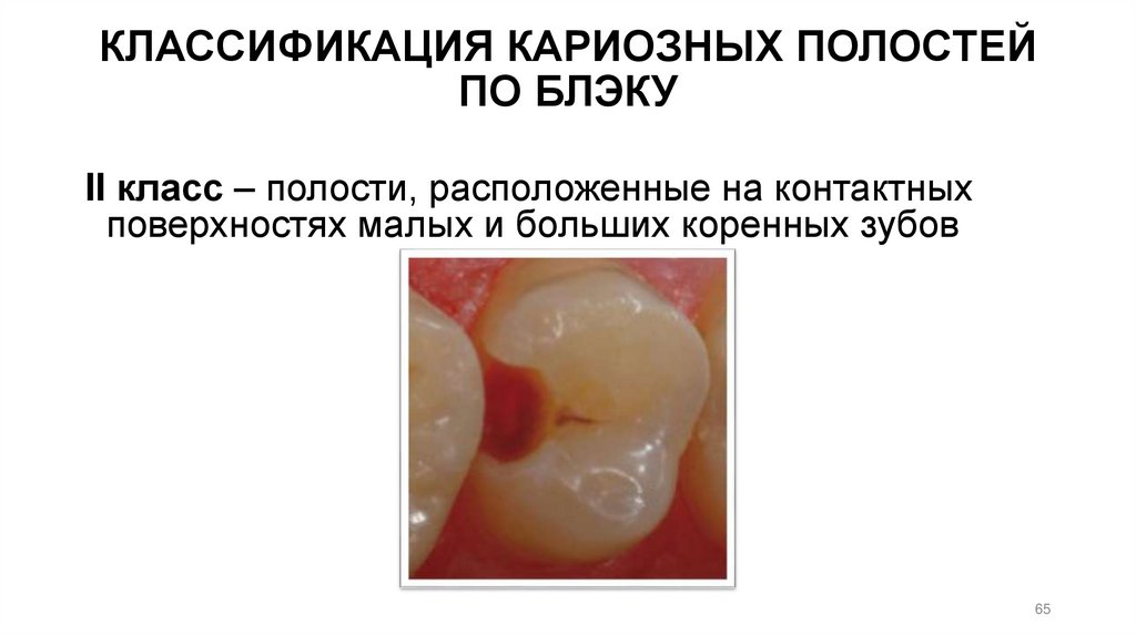 КЛАССИФИКАЦИЯ КАРИОЗНЫХ ПОЛОСТЕЙ ПО БЛЭКУ
