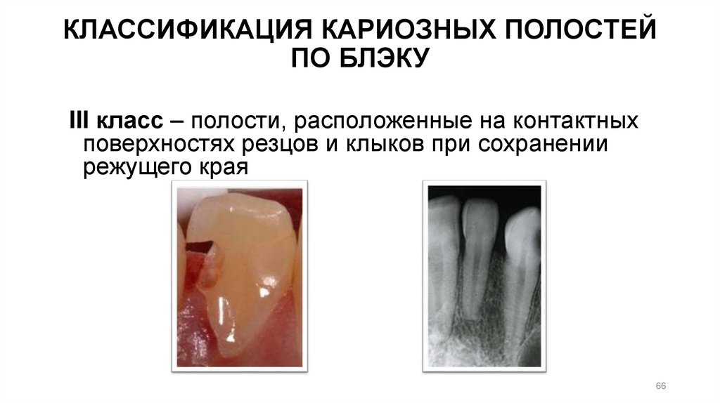 КЛАССИФИКАЦИЯ КАРИОЗНЫХ ПОЛОСТЕЙ ПО БЛЭКУ