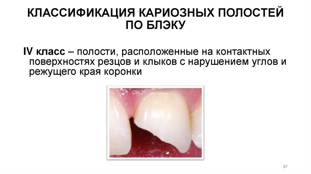 КЛАССИФИКАЦИЯ КАРИОЗНЫХ ПОЛОСТЕЙ ПО БЛЭКУ