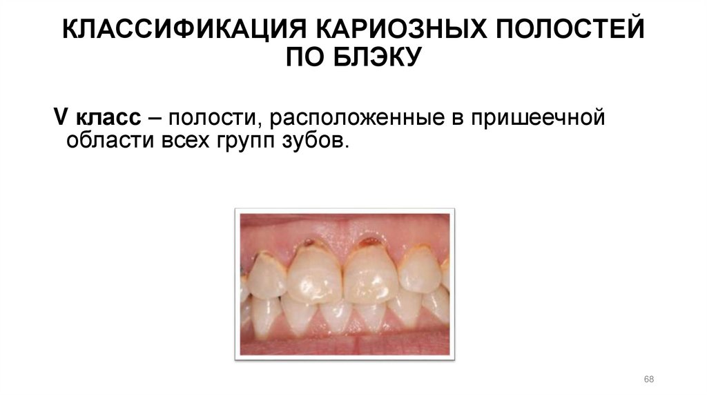 КЛАССИФИКАЦИЯ КАРИОЗНЫХ ПОЛОСТЕЙ ПО БЛЭКУ