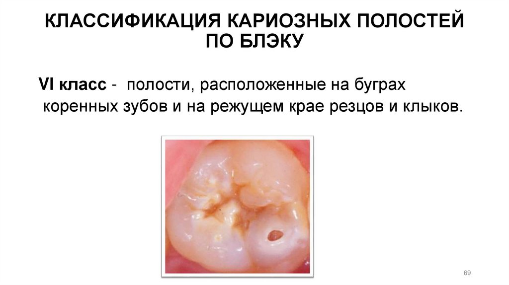 КЛАССИФИКАЦИЯ КАРИОЗНЫХ ПОЛОСТЕЙ ПО БЛЭКУ
