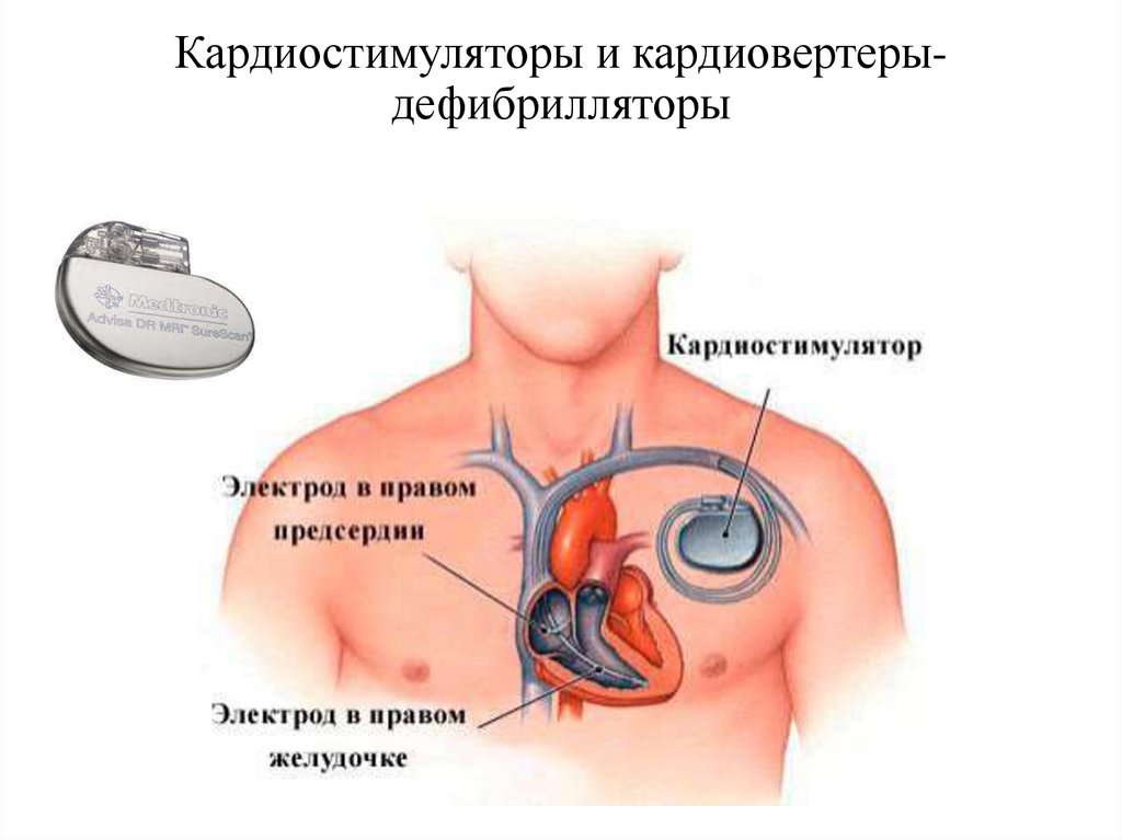 Кардиостимуляторы и кардиовертеры- дефибрилляторы