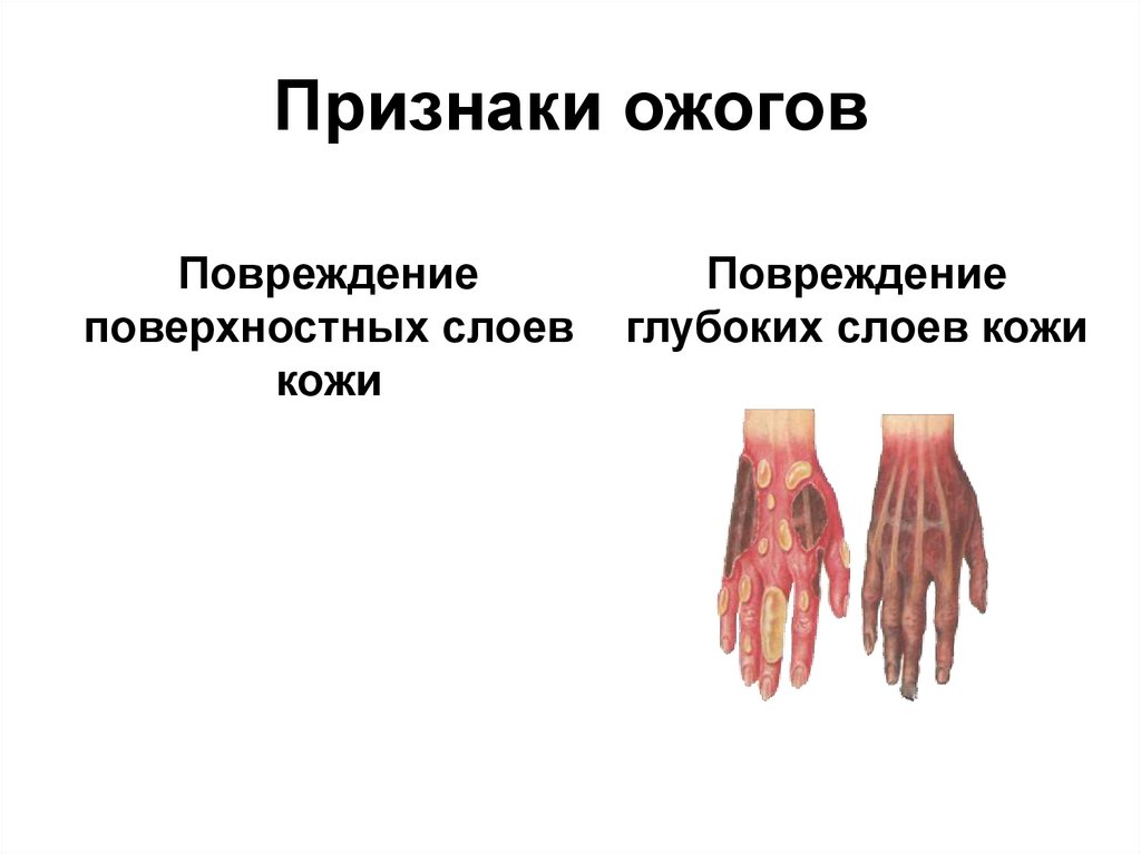 Признаки ожогов