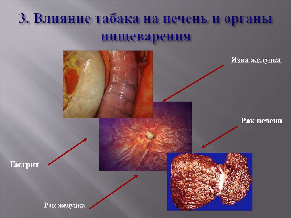 3. Влияние табака на печень и органы пищеварения