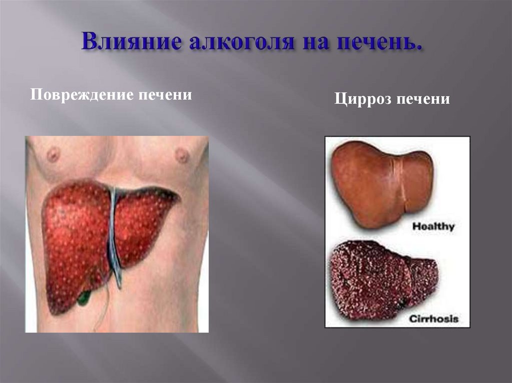 Влияние алкоголя на печень.