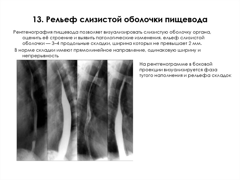 13. Рельеф слизистой оболочки пищевода