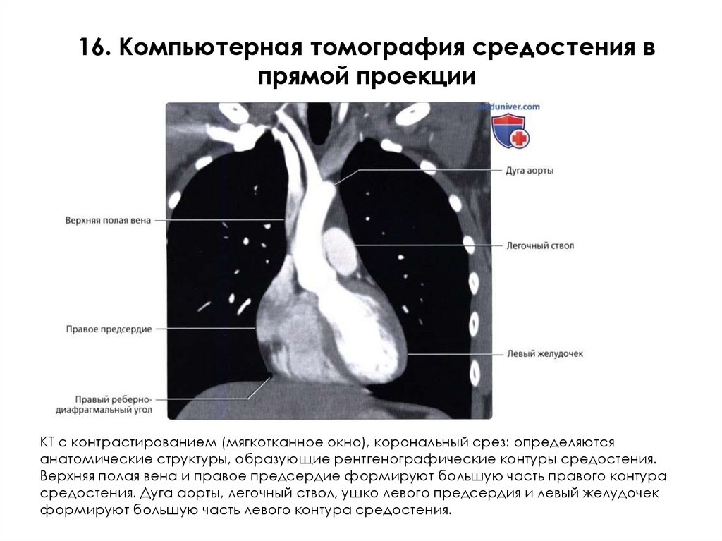 16. Компьютерная томография средостения в прямой проекции