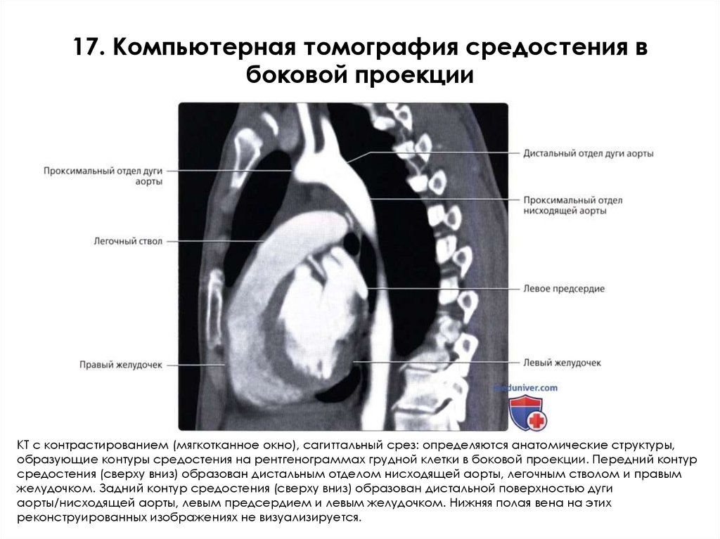 17. Компьютерная томография средостения в боковой проекции