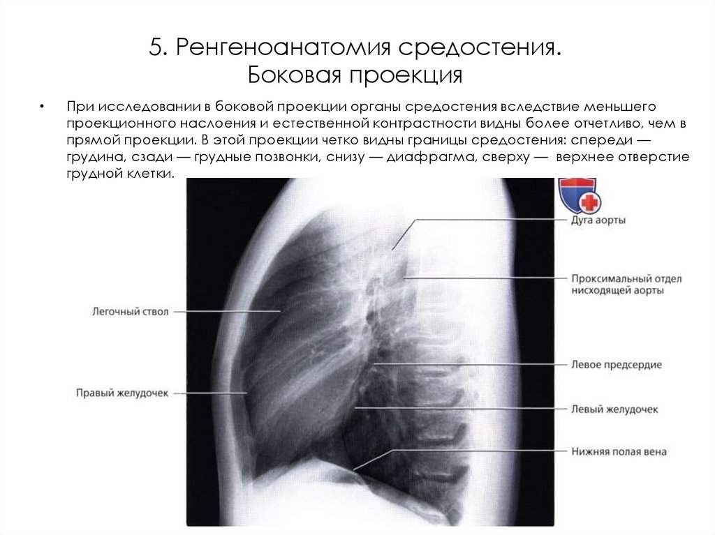 5. Ренгеноанатомия средостения. Боковая проекция