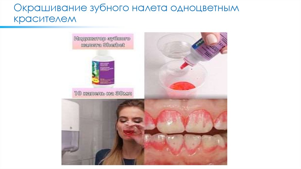Окрашивание зубного налета одноцветным красителем