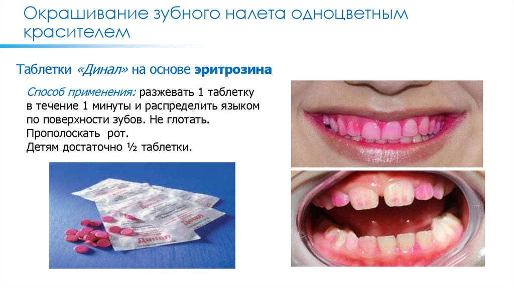 Окрашивание зубного налета одноцветным красителем