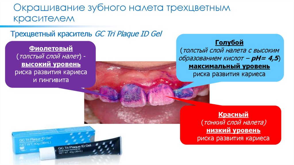 Окрашивание зубного налета трехцветным красителем