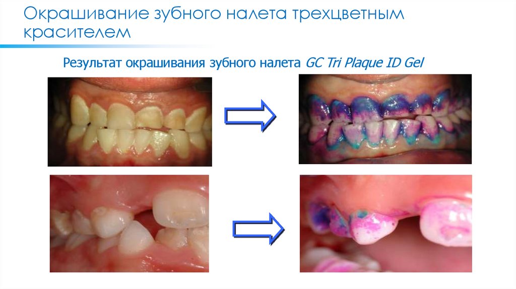 Окрашивание зубного налета трехцветным красителем