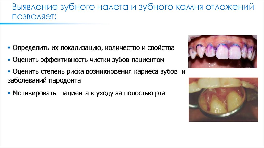 Выявление зубного налета и зубного камня отложений позволяет: