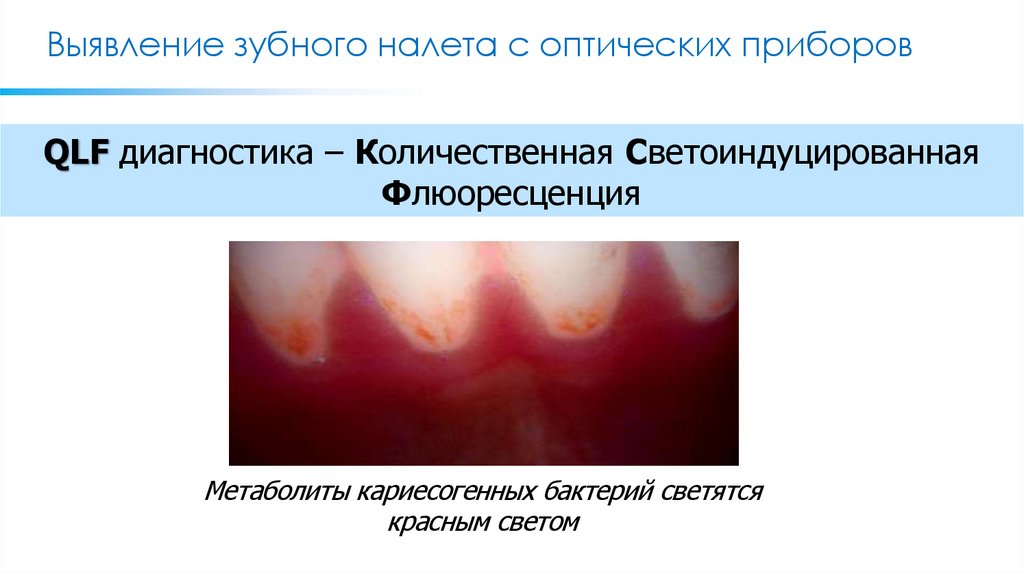 Выявление зубного налета с оптических приборов