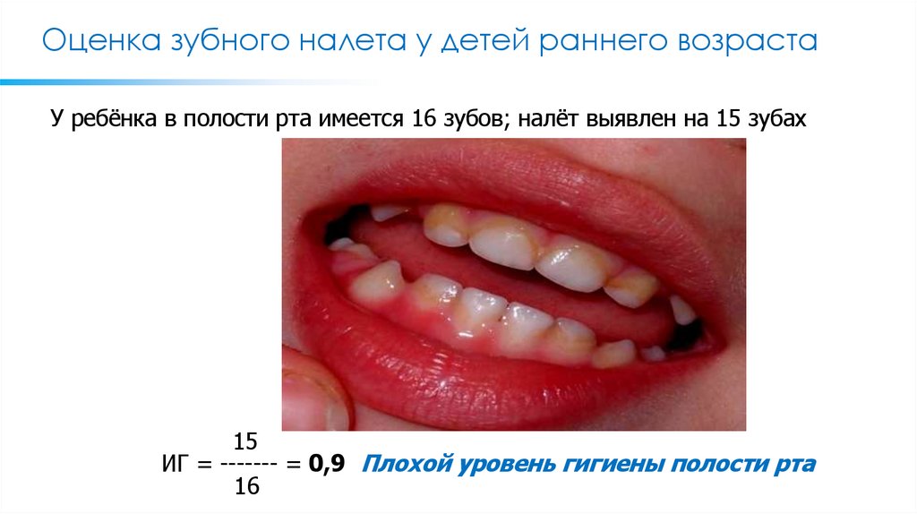 Оценка зубного налета у детей раннего возраста
