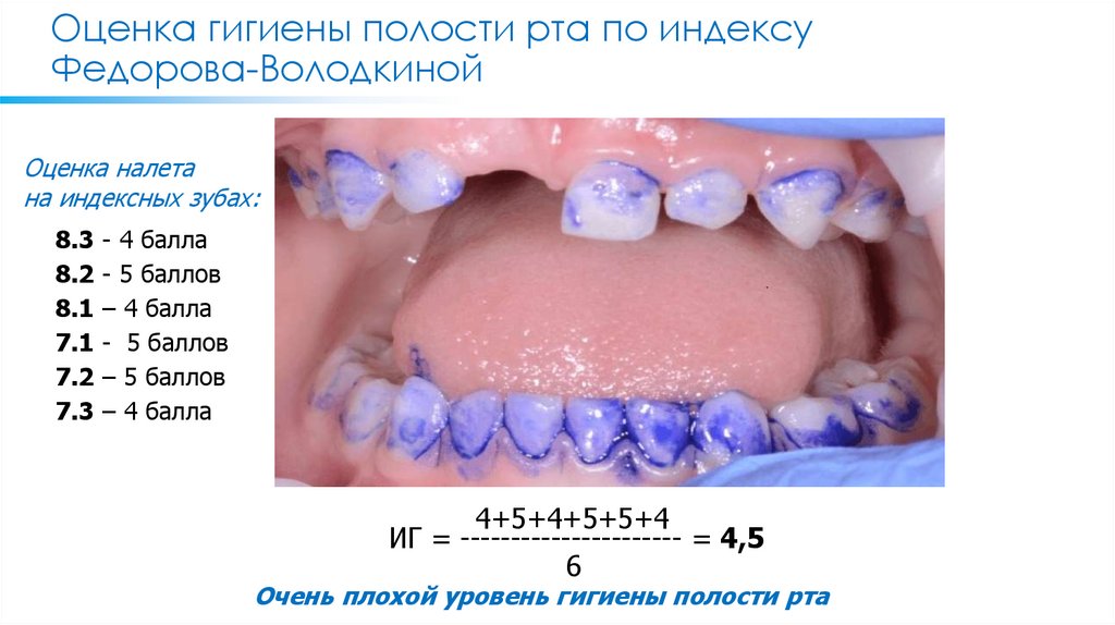 Оценка гигиены полости рта по индексу Федорова-Володкиной