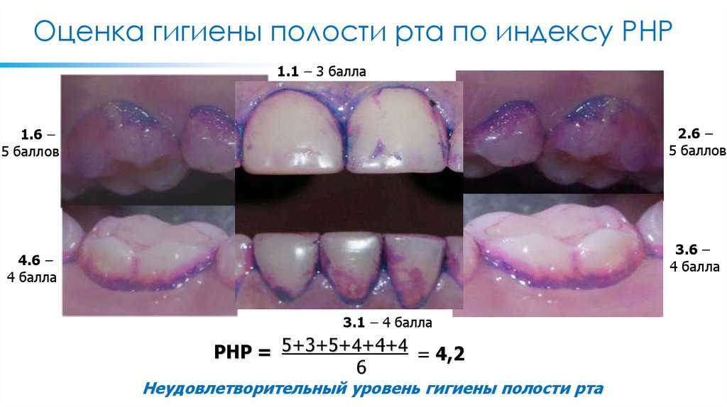 Оценка гигиены полости рта по индексу РНР