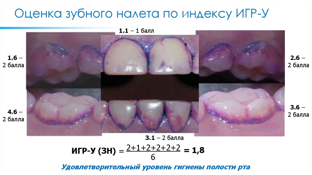 Оценка зубного налета по индексу ИГР-У
