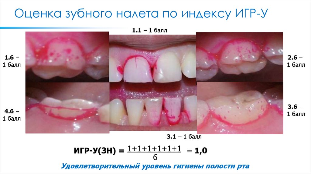 Оценка зубного налета по индексу ИГР-У