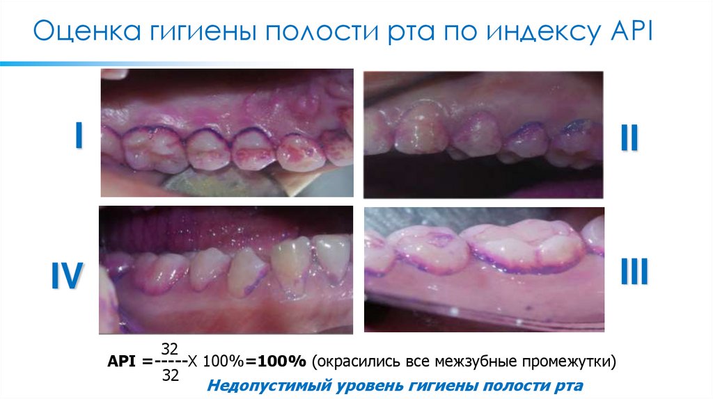 Оценка гигиены полости рта по индексу API