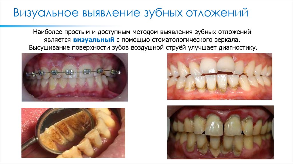 Визуальное выявление зубных отложений