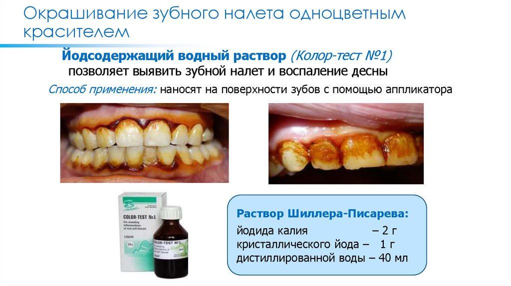 Окрашивание зубного налета одноцветным красителем